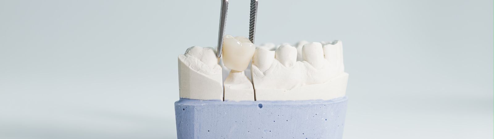 Porcelain Crowns (Caps)