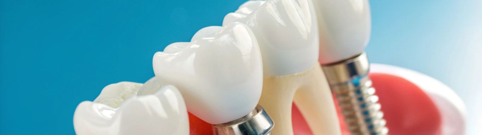 Porcelain Fixed Bridges