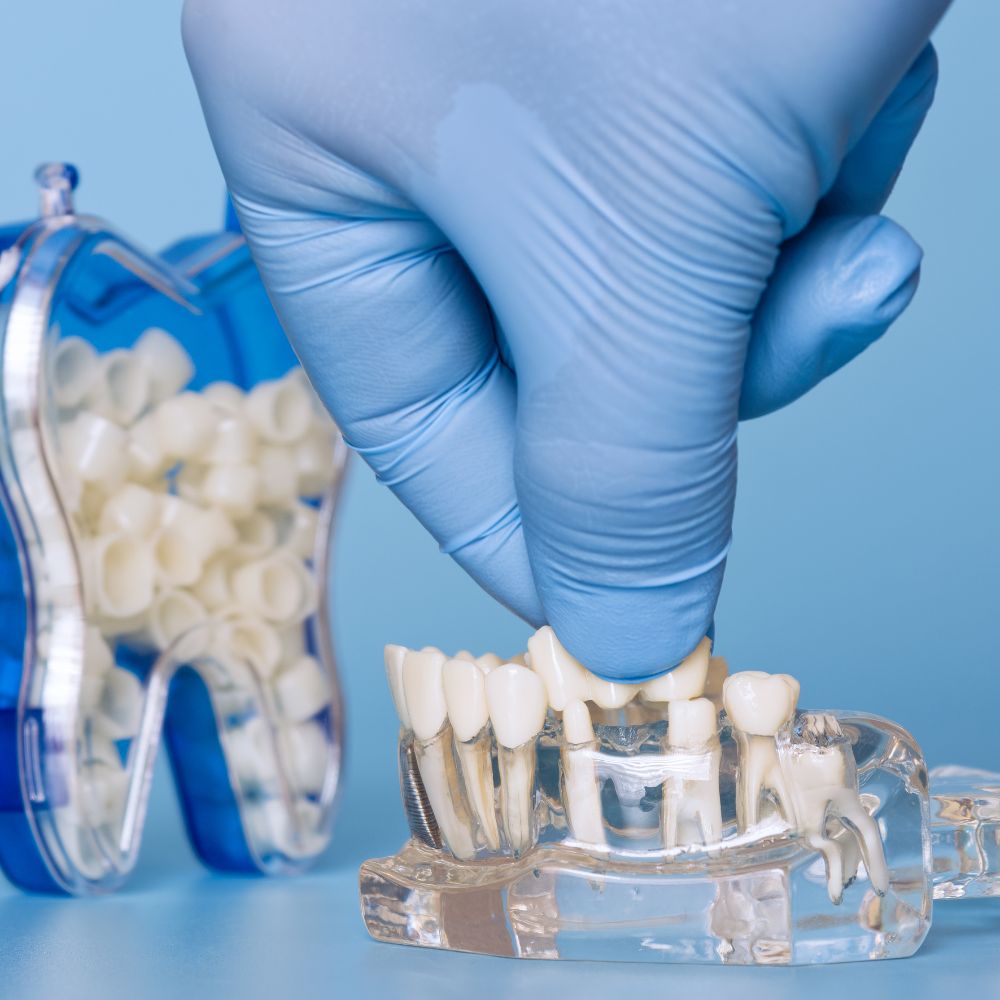 Porcelain Fixed Bridges